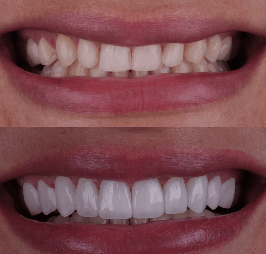 Depois — Resultado real