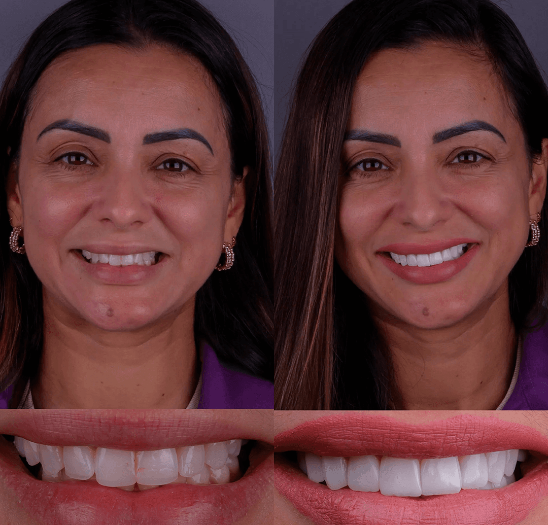 Depois — Resultado real