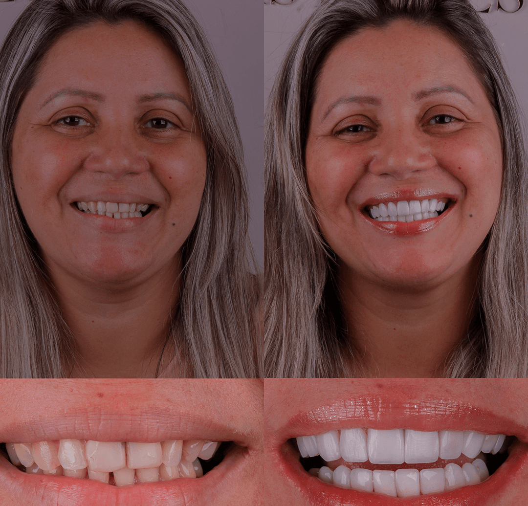 Depois — Resultado real